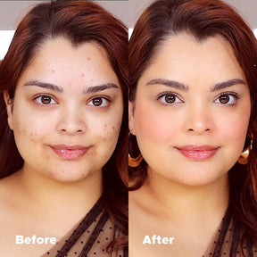 Universal Foundation before and after comparison showing seamless coverage of acne for a natural matte finish.